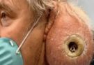 Their acne is severe